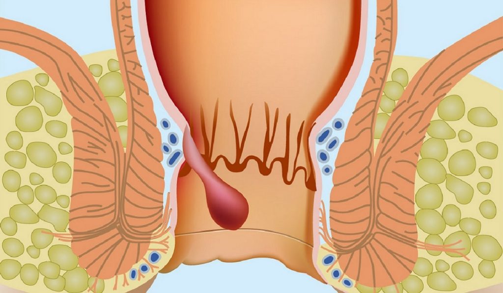 Hemoroid (Basur) Nedir? Nedenleri, Belirtileri, Korunma Yolları ve Tedavisi