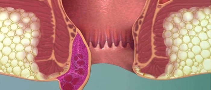 Hemoroidin Belirtileri Nelerdir?