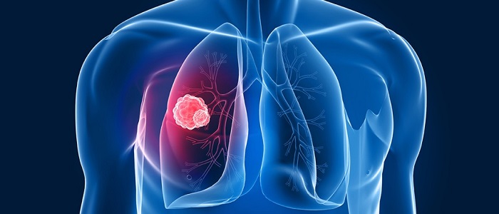 Akciğer Kanserinin Belirtileri Nelerdir?