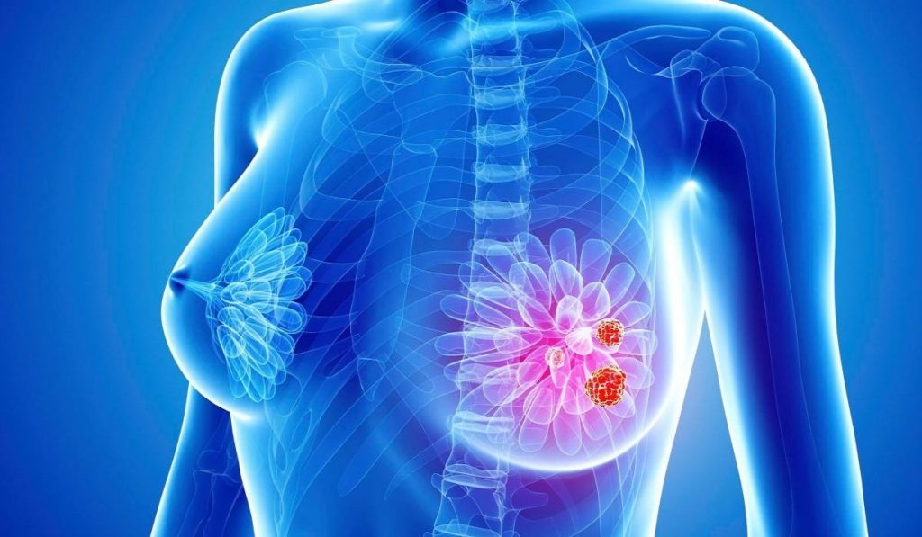 Meme Kanseri Nedir? Nedenleri? Belirtileri, Korunma Yolları ve Tedavisi