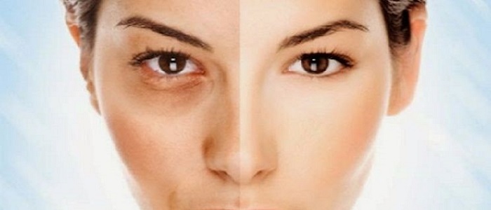 Gözaltı Morluğu Nedir?