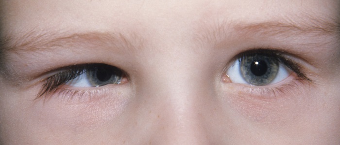 Şaşılığın Nedenleri (Sebepleri) Nelerdir?