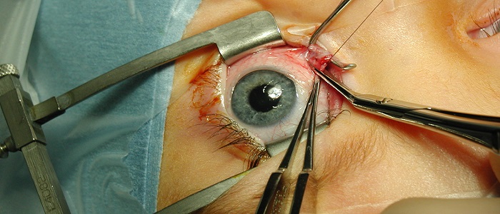 Şaşılığın Tedavisi