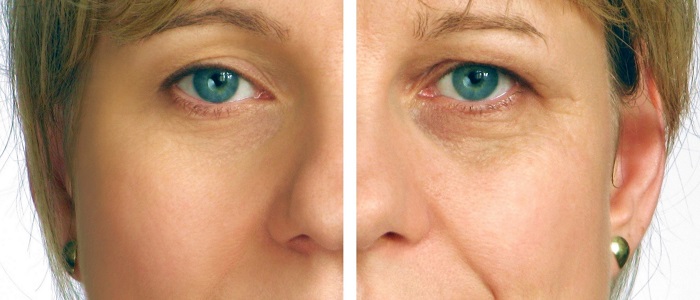 Botox Nasıl Etki Eder?