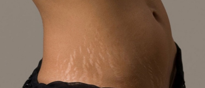 Derideki Çatlaklar Neden Oluşur?