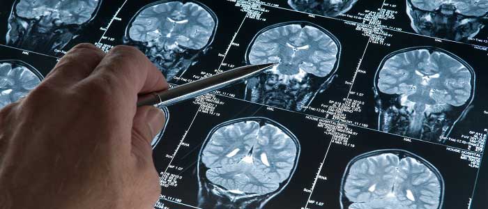 Alzheimer'ın Belirtileri Nelerdir?