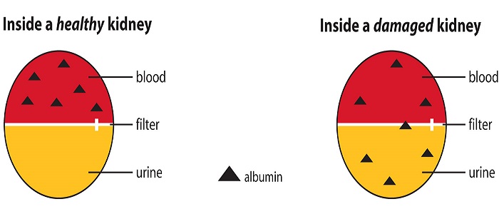 Albümin Hastalığının Nedenleri Nelerdir?