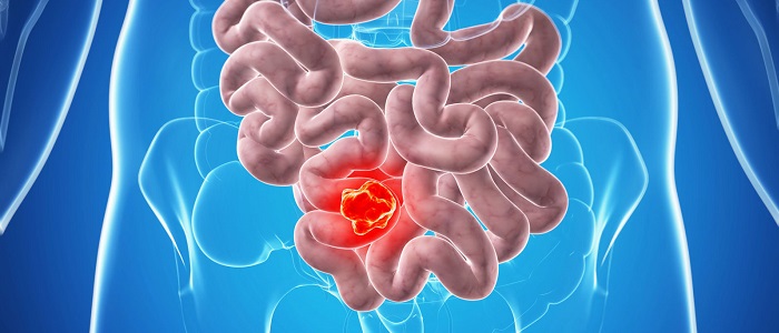 Kolon (Kalın Bağırsak) Kanseri Nedir?