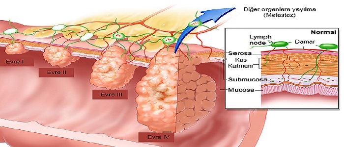 Kolon Kanserinin Evreleri Nelerdir?