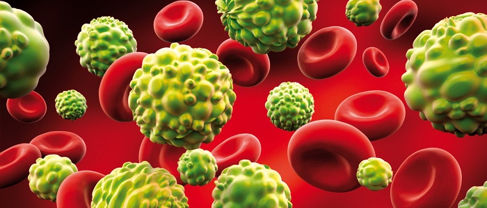 Lösemi (Kan Kanseri) Nedir?