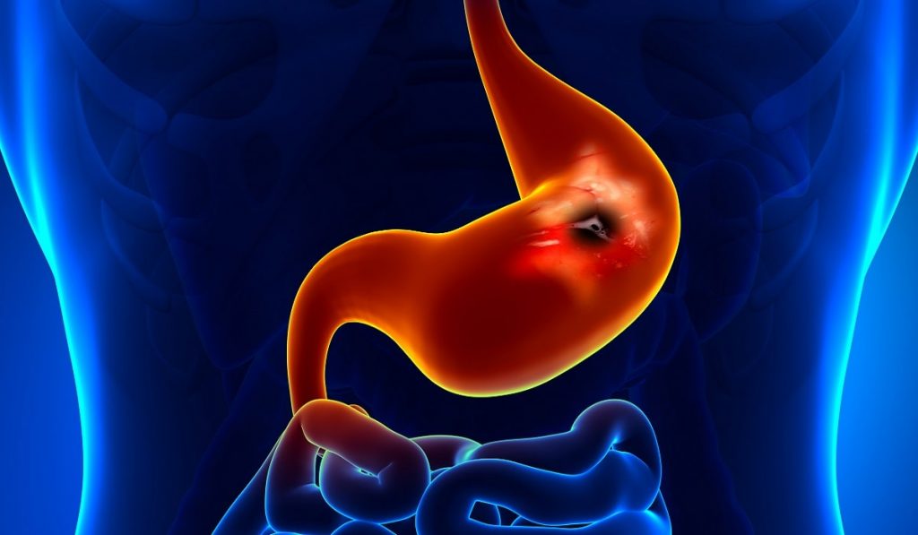 Mide Kanseri Nedir? Nedenleri, Belirtileri, Korunma Yolları ve Tedavisi