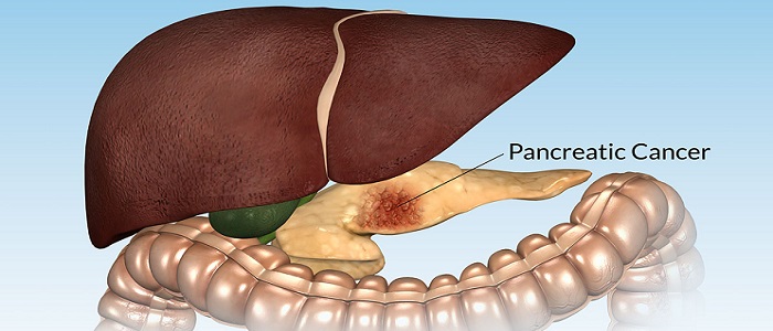 Pankreas Kanserinin Türleri Nelerdir?