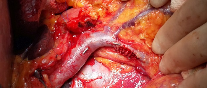 Pankreas Kanserinin Tedavi Yöntemleri Nelerdir?