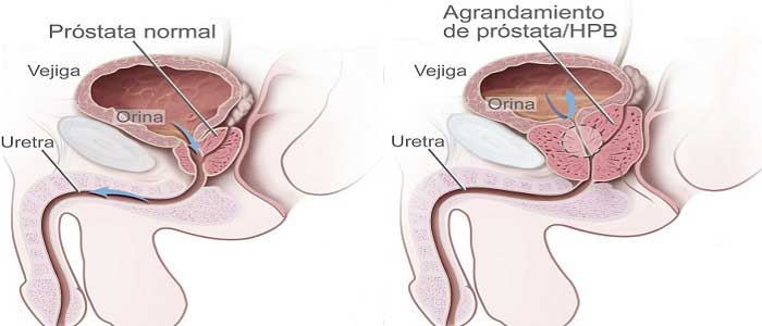 Prostat Kanseri Nedir?