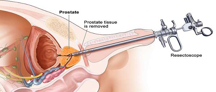 Prostat Kanserinin Tedavisi Nedir?