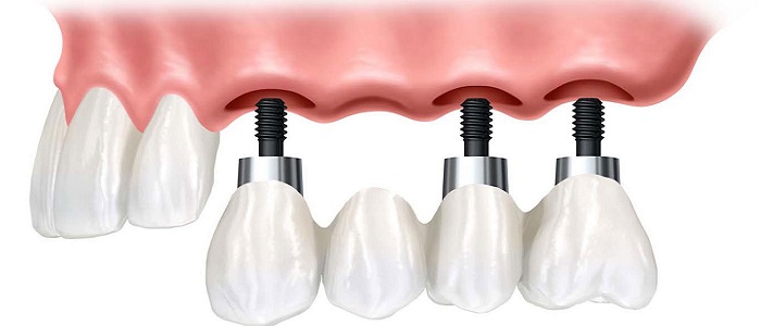 Protez Diş Çeşitleri Nelerdir? Protez Diş Çeşitleri Nelerdir?