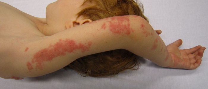 Zona Hastalığı Nedir?