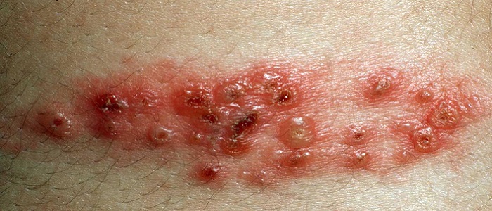 Zona Hastalığının Belirtileri Nelerdir?