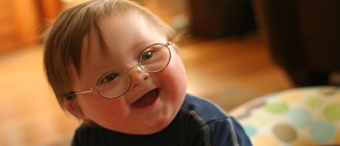 Down Sendromu Nedir?