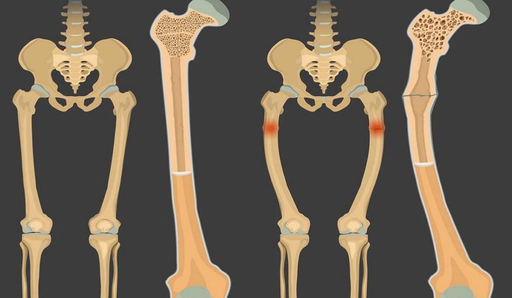 Raşitizm Nedir? Nedenleri, Belirtileri, Korunma Yolları ve Tedavisi