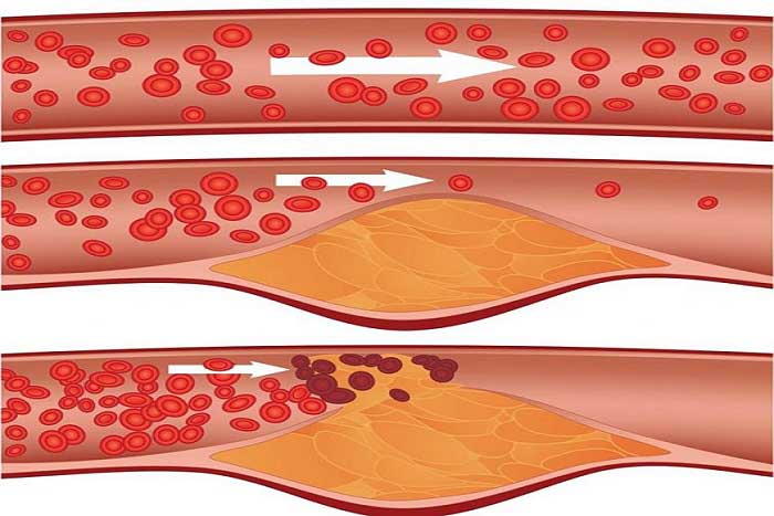 Damar Tıkanıklığı (Ateroskleroz) Nedir? Nedenleri, Belirtileri, Korunma Yolları ve Tedavisi
