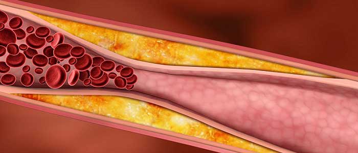 Damar Tıkanıklığı (Ateroskleroz) Nedir?