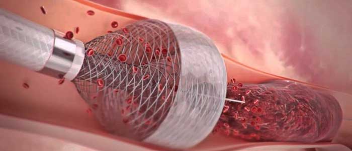 Damar Tıkanıklığının Tedavisi Nedir?