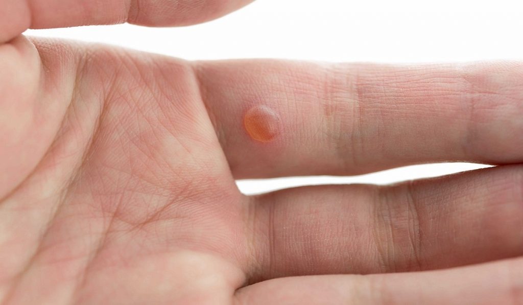 Siğil Nedir? Nedenleri, Belirtileri, Korunma Yolları ve Tedavisi