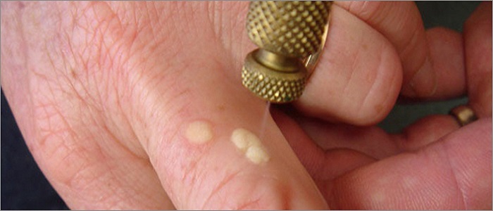 Siğil Nasıl Tedavi Edilir?