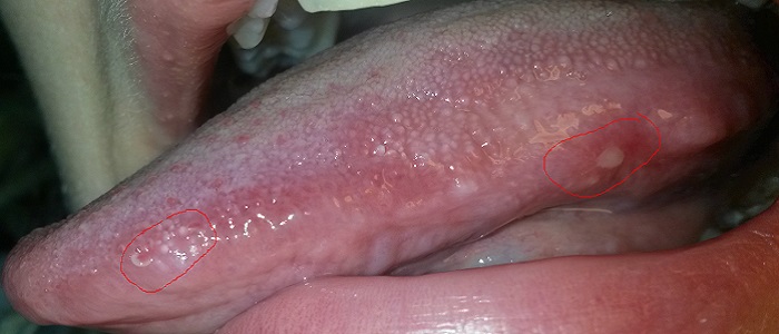 Dil Ülserinin Belirtileri Nelerdir?