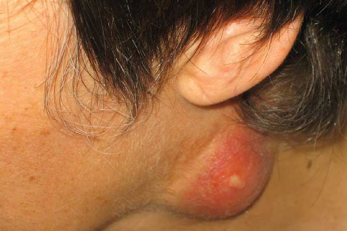 Tularemi Hastalığı Nedir? Nedenleri, Belirtileri, Korunma Yolları ve Tedavisi