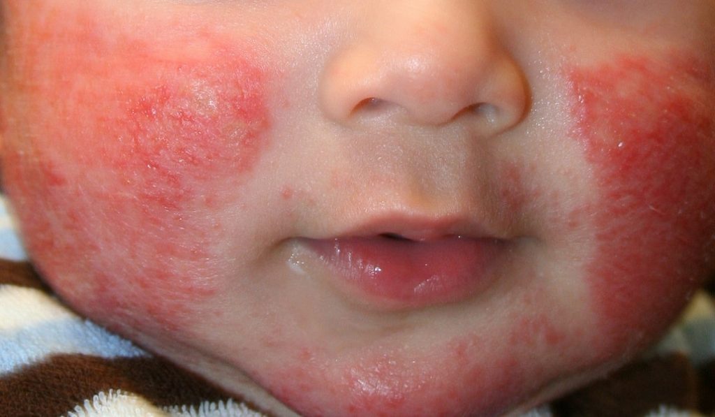 Egzama (Seboreik Dermatit) Nedir? Nedenleri, Belirtileri, Korunma Yolları ve Tedavisi