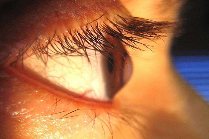 Keratokonus Nedir? Nedenleri, Belirtileri, Korunma Yolları ve Tedavisi