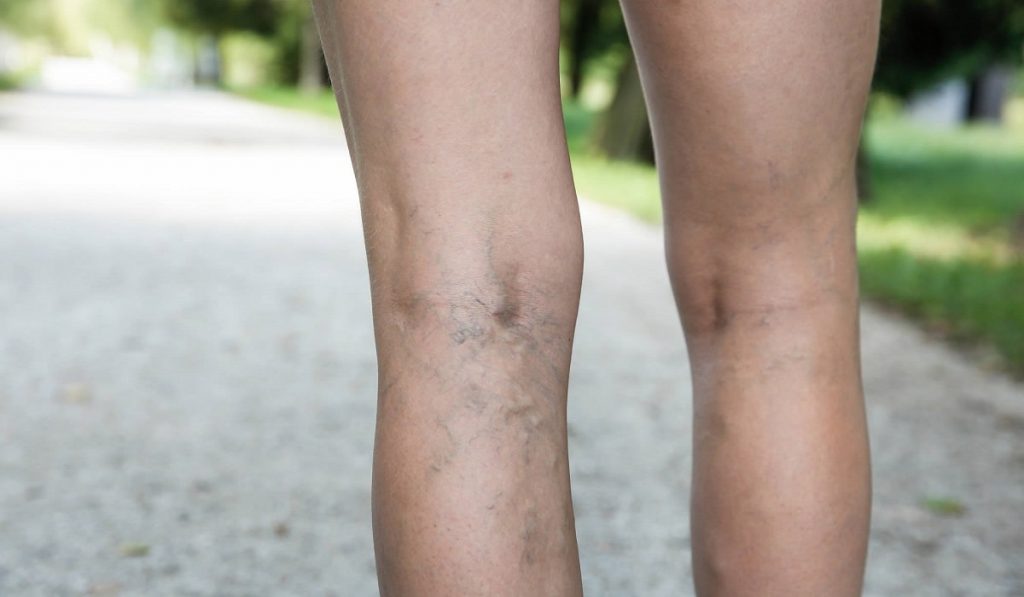 Varis Nedir? Nedenleri, Belirtileri, Korunma Yolları ve Tedavisi