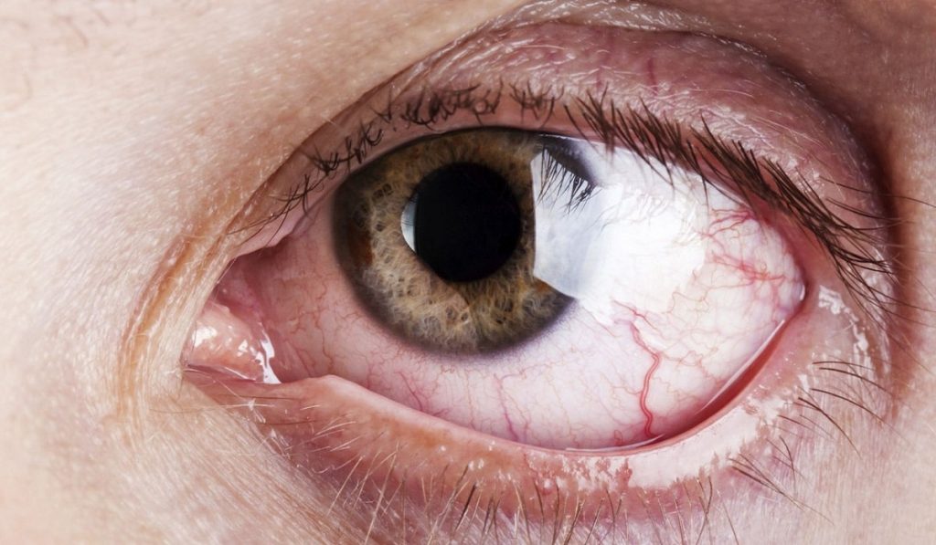 Alerjik Konjonktivit Nedir? Nedenleri, Belirtileri, Korunma Yolları ve Tedavisi