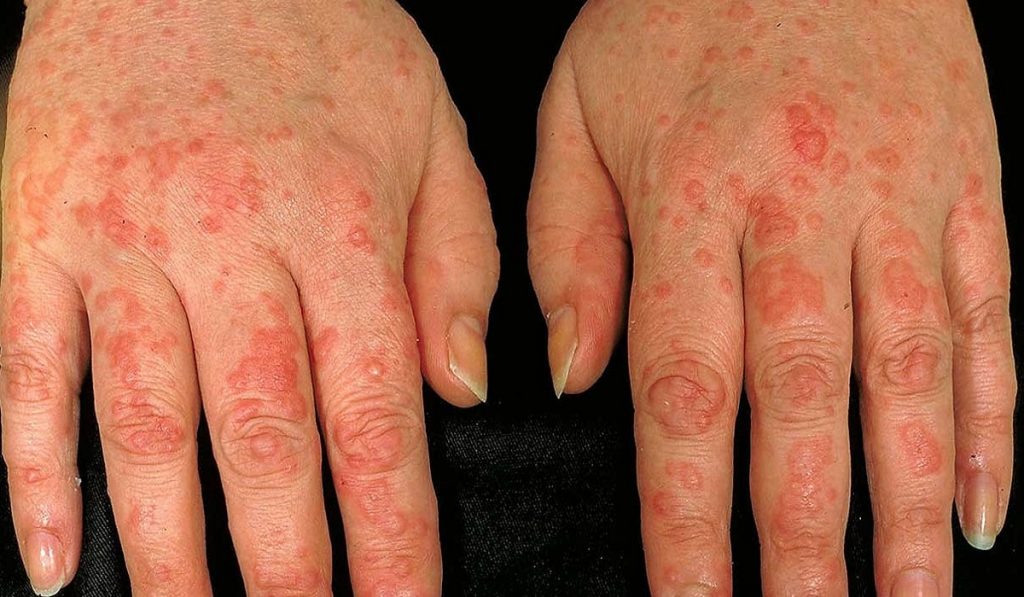 Kurdeşen Hastalığı (Ürtiker) Nedir? Nedenleri, Belirtileri, Korunma Yolları ve Tedavisi