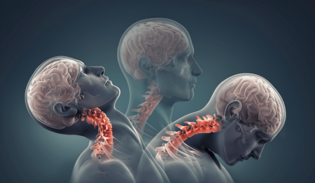 Boyun Düzleşmesi Nedir? Nedenleri, Belirtileri, Korunma Yolları ve Tedavisi