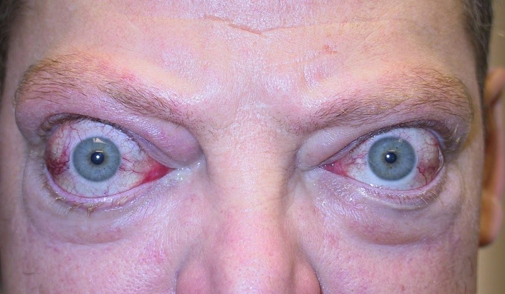 Graves (Basedow) Hastalığı Nedir? Nedenleri, Belirtileri, Korunma Yolları ve Tedavisi