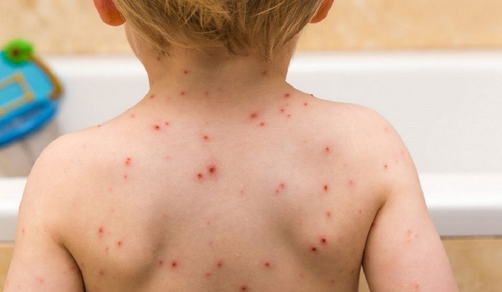 Su Çiçeği Hastalığı Nedir? Nedenleri, Belirtileri, Korunma Yolları ve Tedavisi