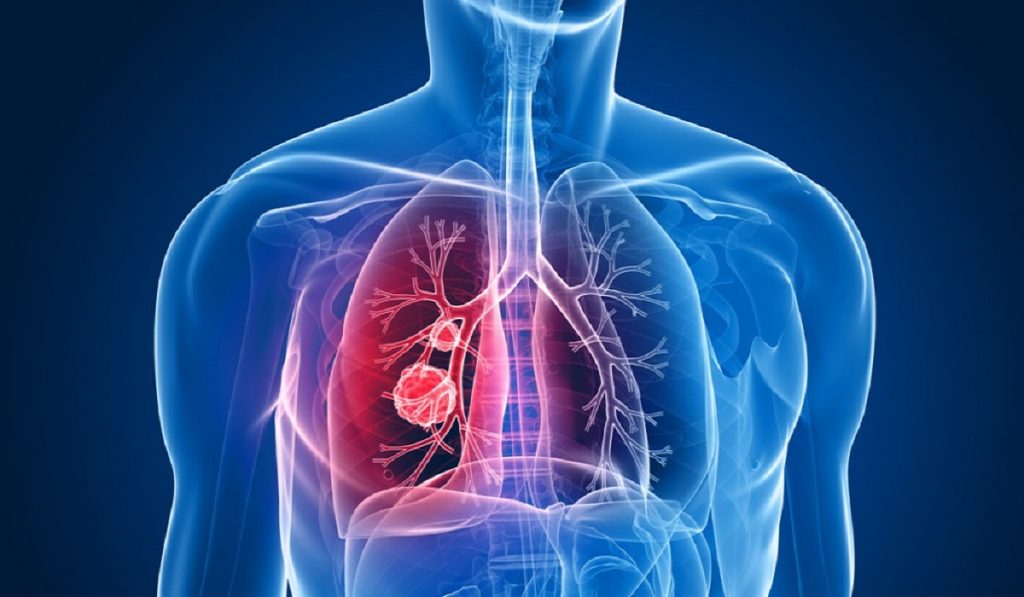 Zatürre Nedir? Nedenleri, Belirtileri, Korunma Yolları ve Tedavisi