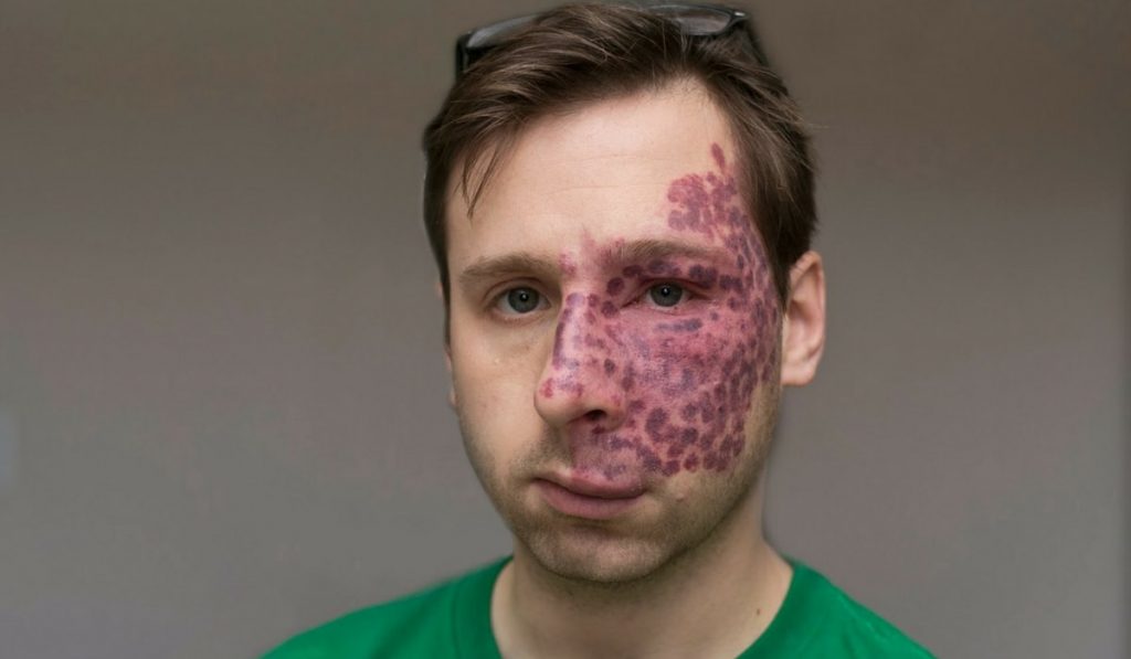 Doğum Lekesi Nedir? Nedenleri, Belirtileri, Korunma Yolları ve Tedavisi