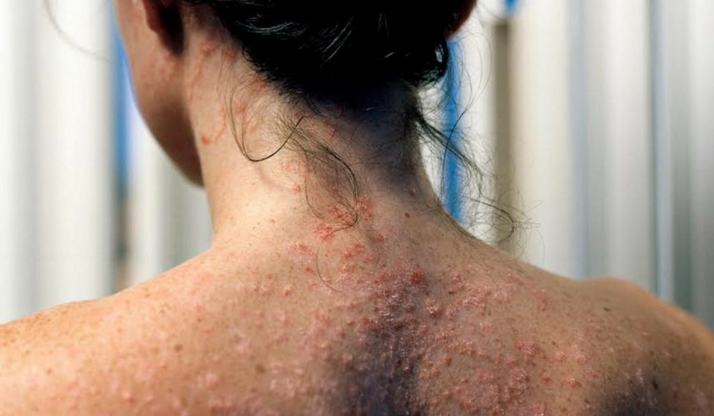 Sedef Hastalığı Nedir? Nedenleri, Belirtileri, Korunma Yolları ve Tedavisi