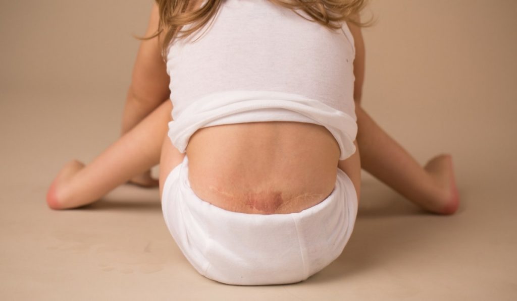 Spina Bifida Hastalığı Nedir? Nedenleri, Belirtileri, Korunma Yolları ve Tedavisi