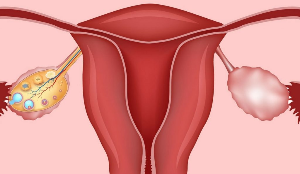 Polikistik Over Sendromu Nedir? Nedenleri, Belirtileri, Korunma Yolları ve Tedavisi